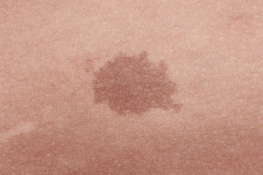 Birthmark treatment at Dr. Kamil Al Rustom Skin and Laser Centre Dubai Birthmark treatment at Dr. Kamil Al Rustom Skin and Laser Centre Dubai
